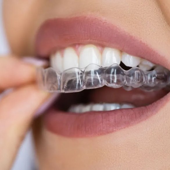 Braces & Aligners