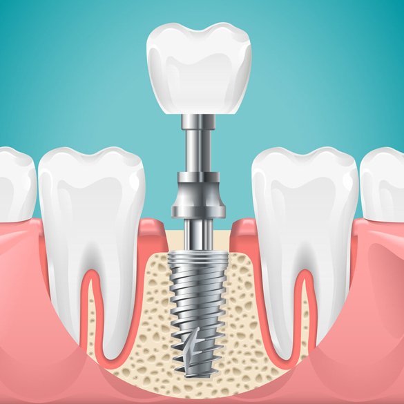Dental Implants